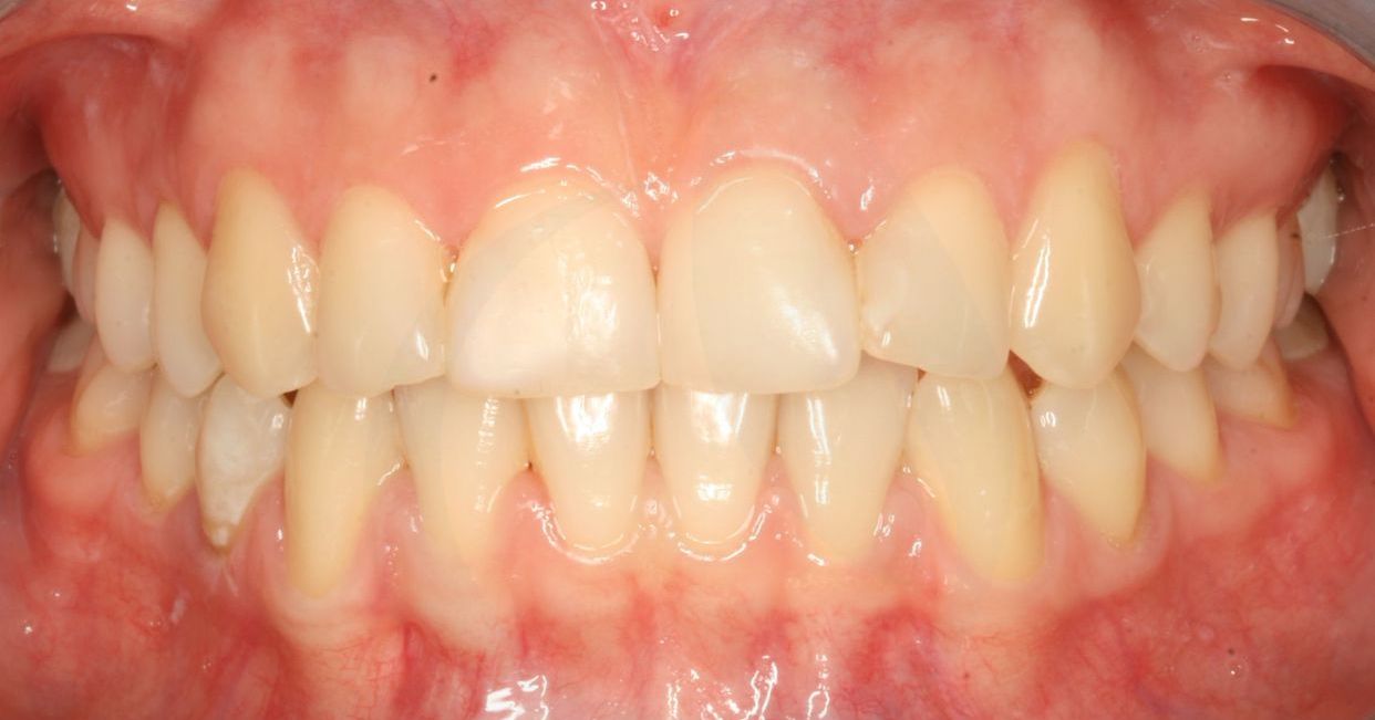 Clear aligner treatment — before