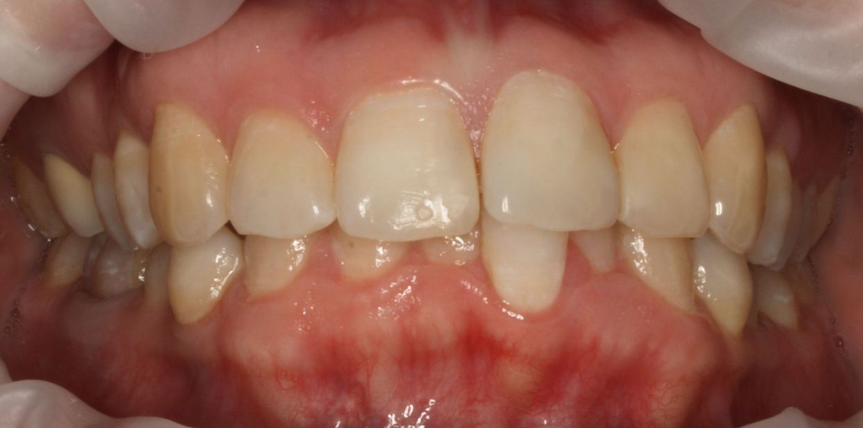 Clear aligner treatment — before