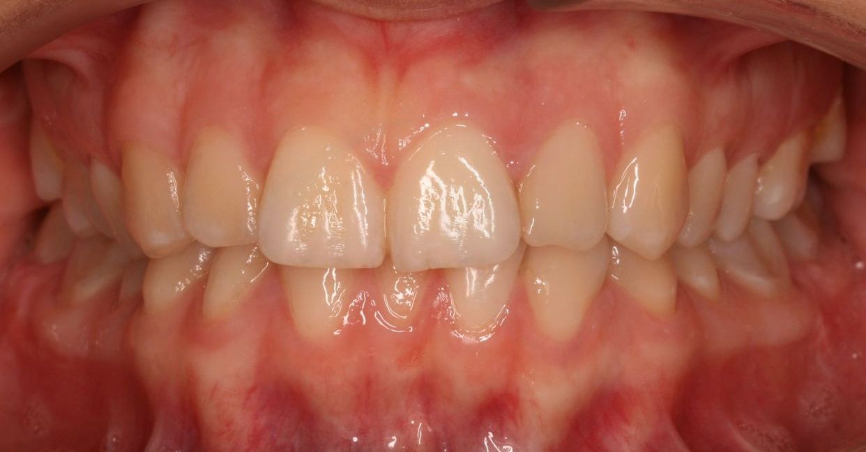 Clear aligner treatment — before