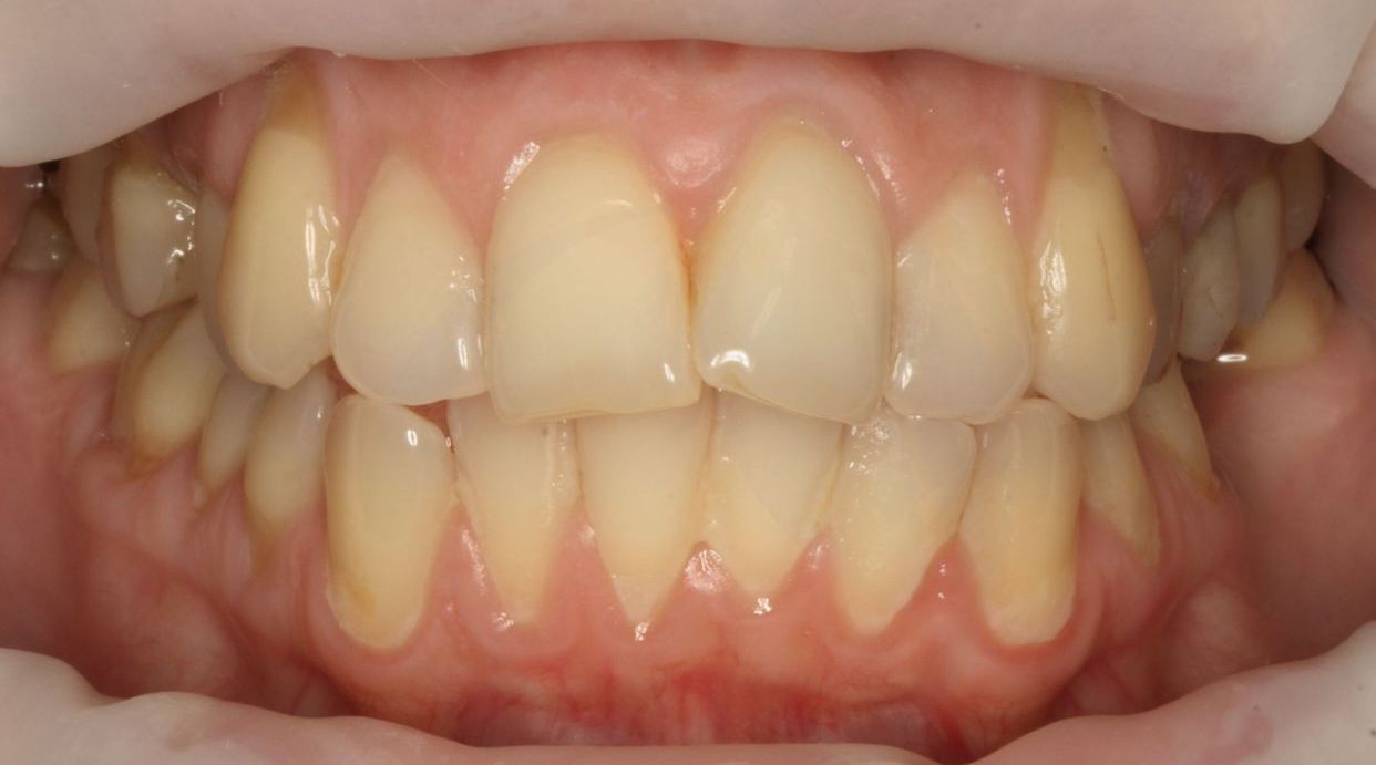 Clear aligner treatment — before