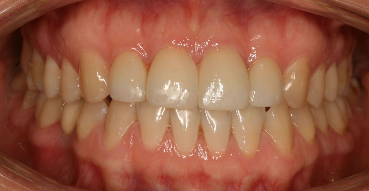 Clear aligner treatment — after