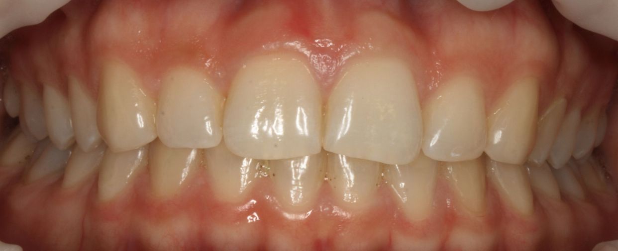 Clear aligner treatment — after