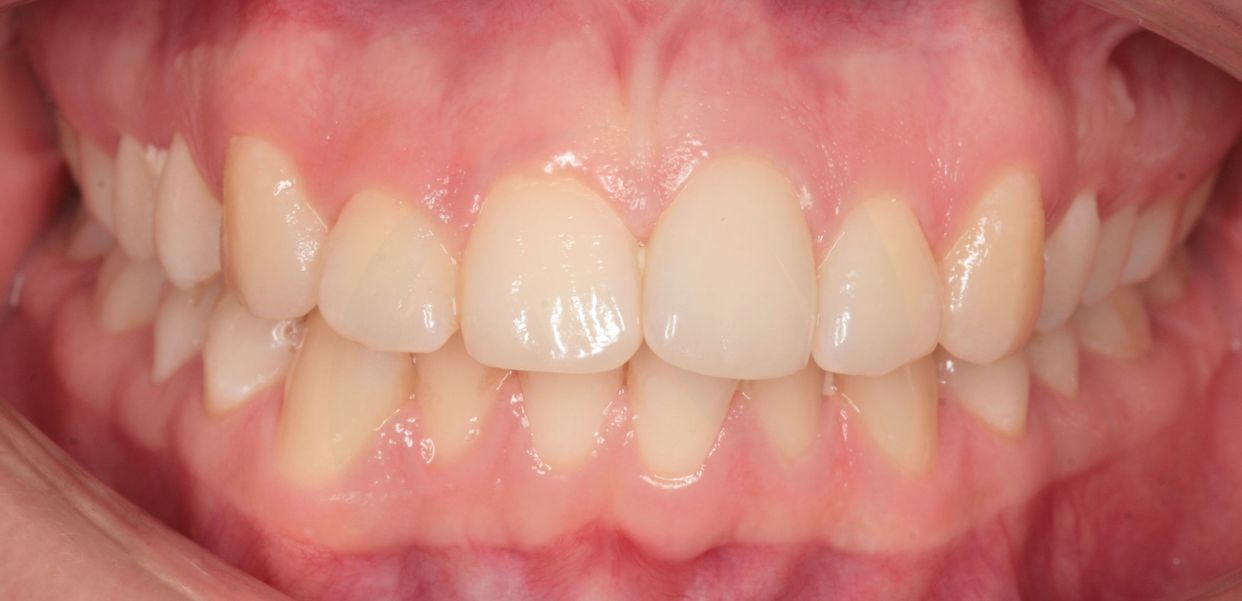 Clear aligner treatment — before