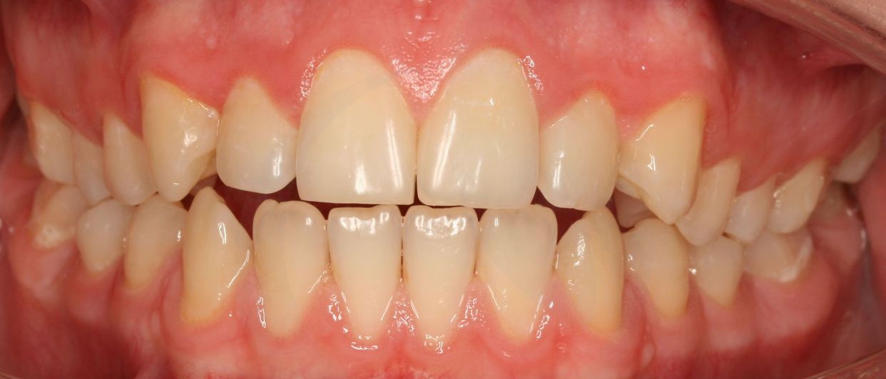 Clear aligner treatment — after