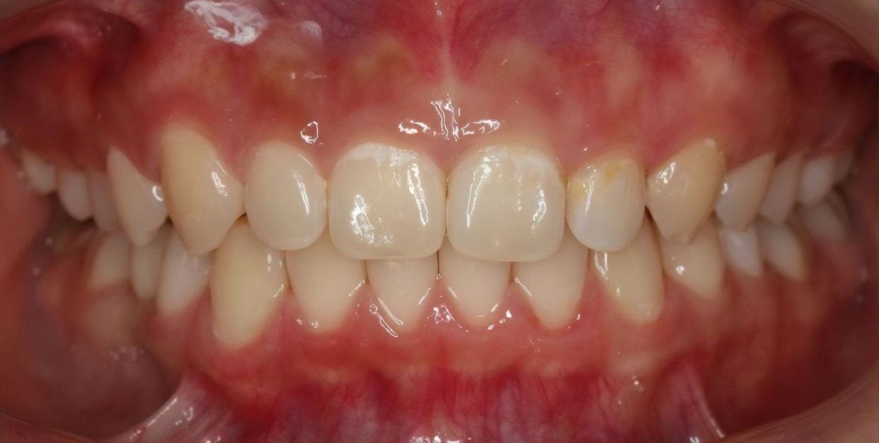 Clear aligner treatment — after