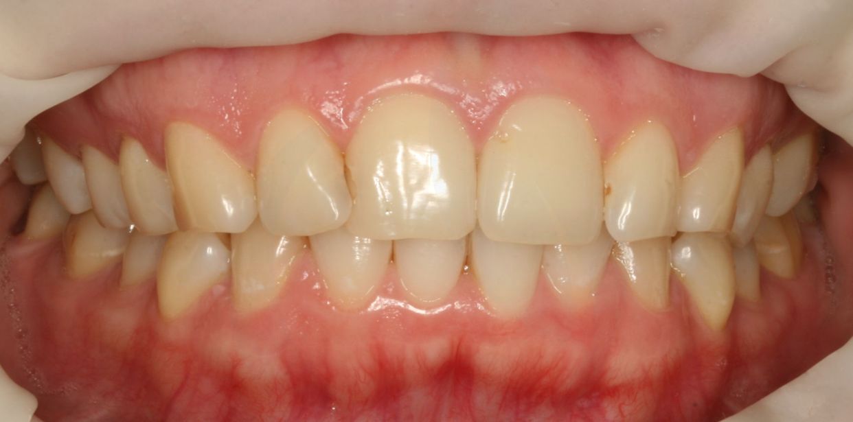 Clear aligner treatment — before