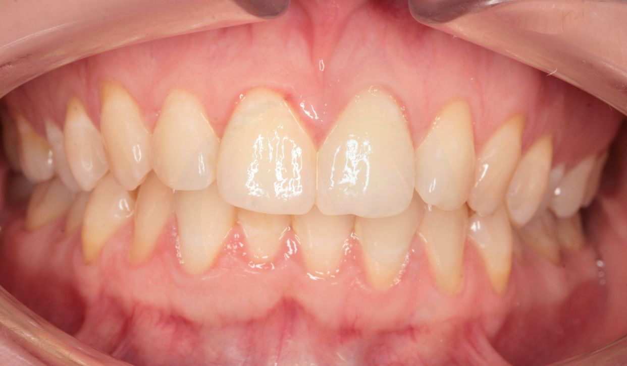 Clear aligner treatment — before