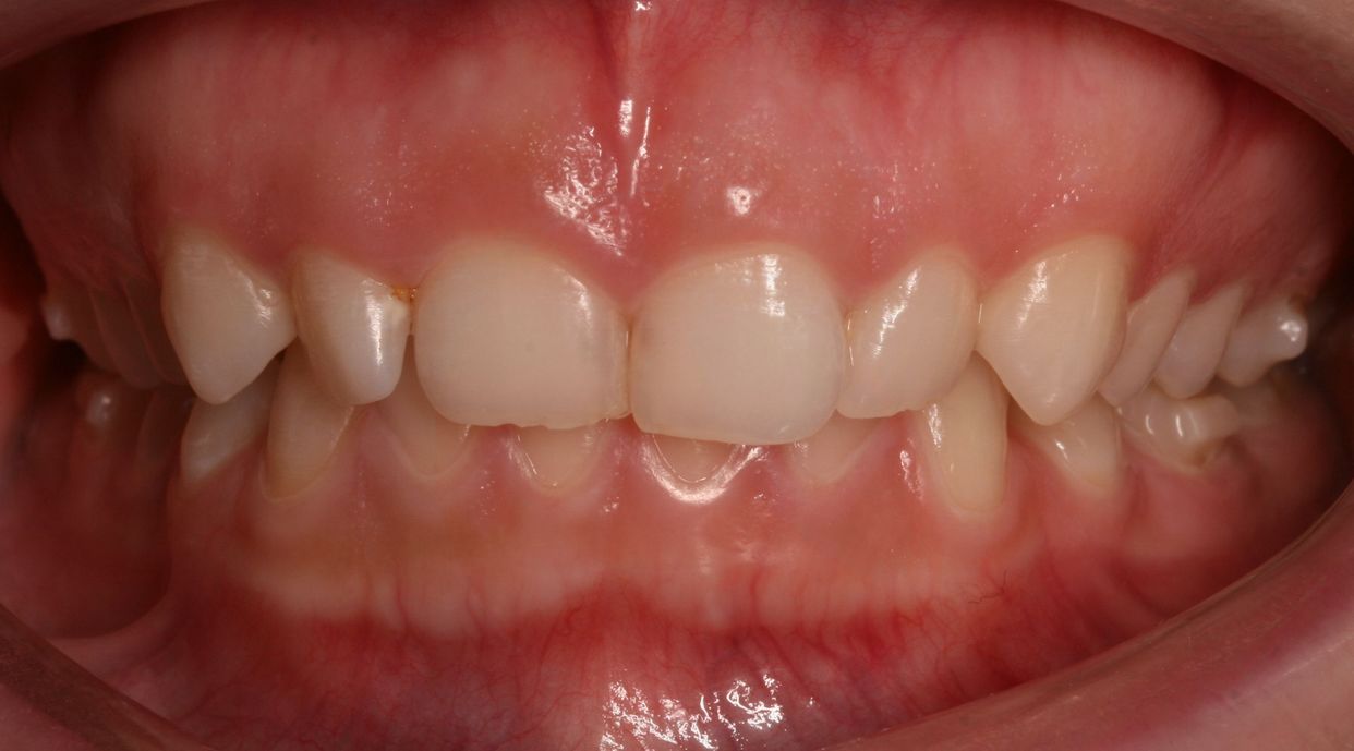 Clear aligner treatment — before