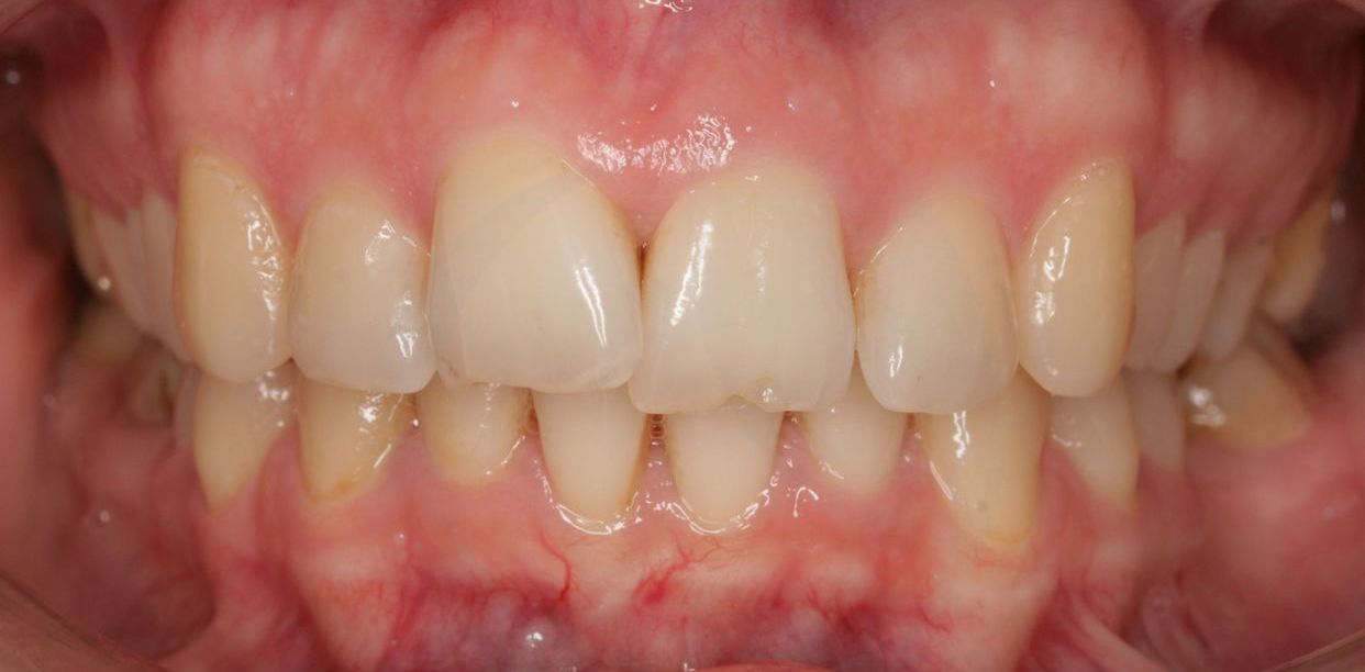 Clear aligner treatment — before