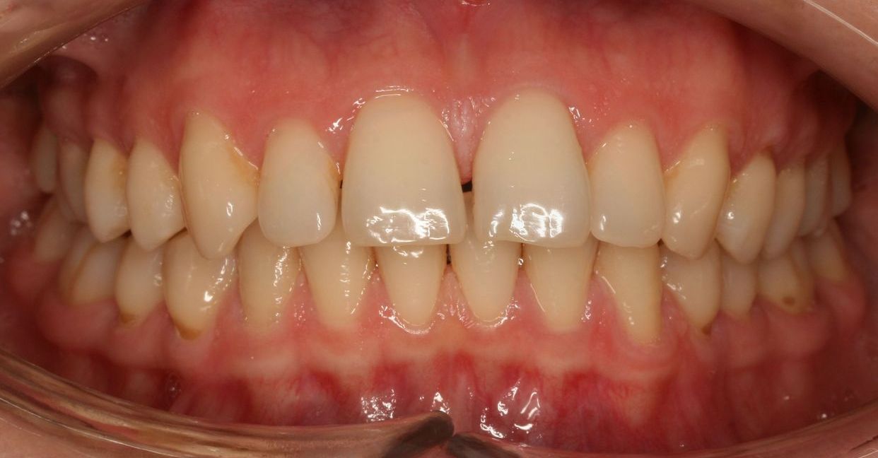 Clear aligner treatment — before
