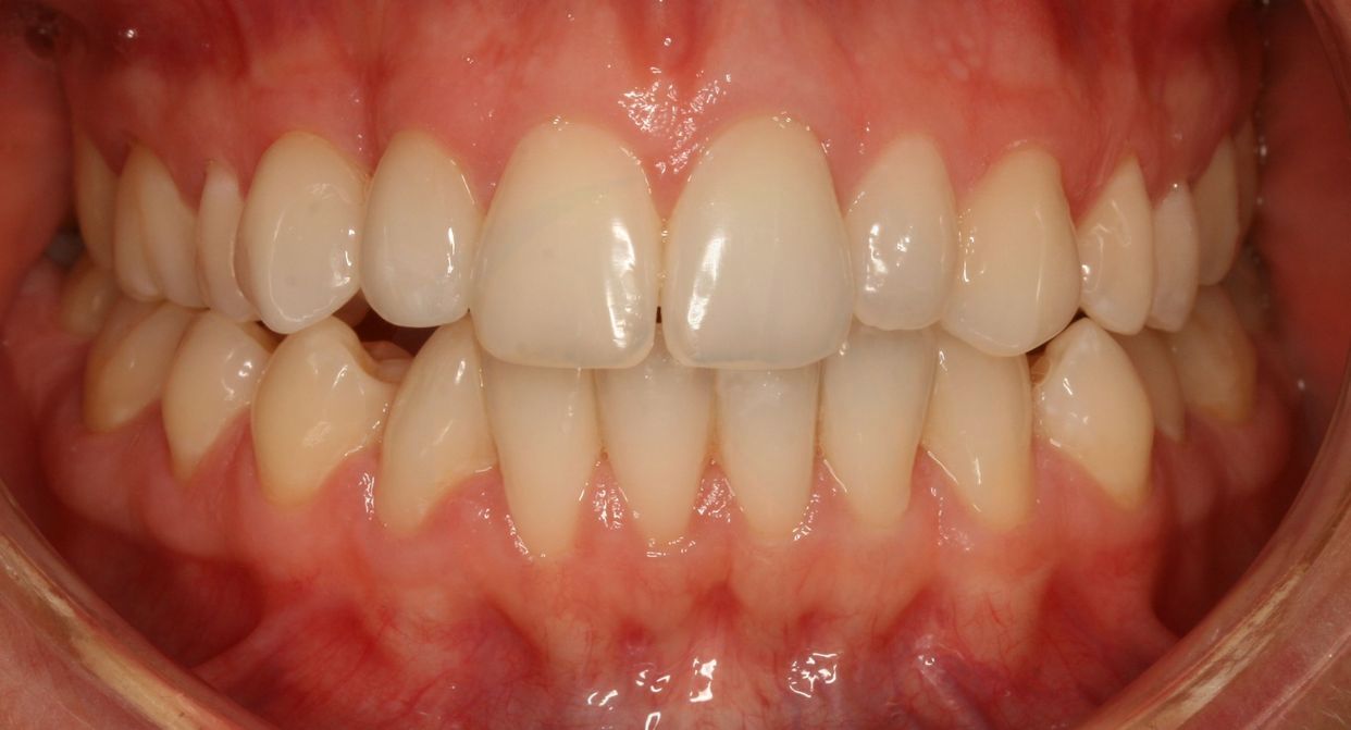 Clear aligner treatment — after