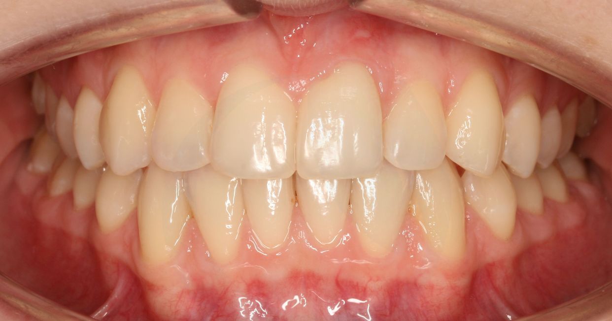 Clear aligner treatment — after