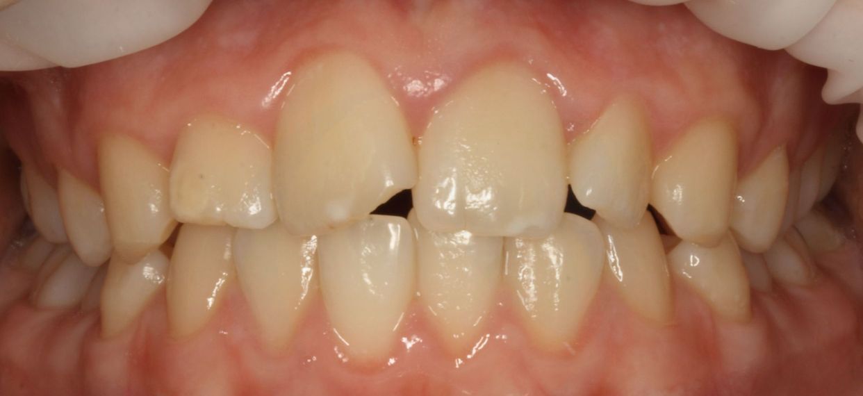 Clear aligner treatment — before
