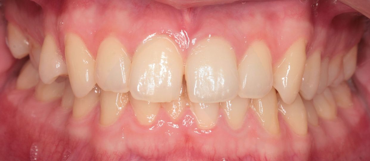 Clear aligner treatment — before