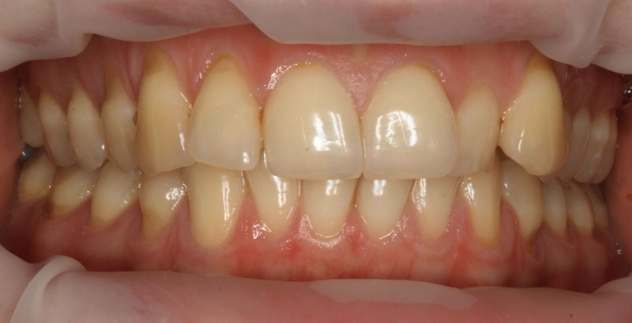 Clear aligner treatment — before