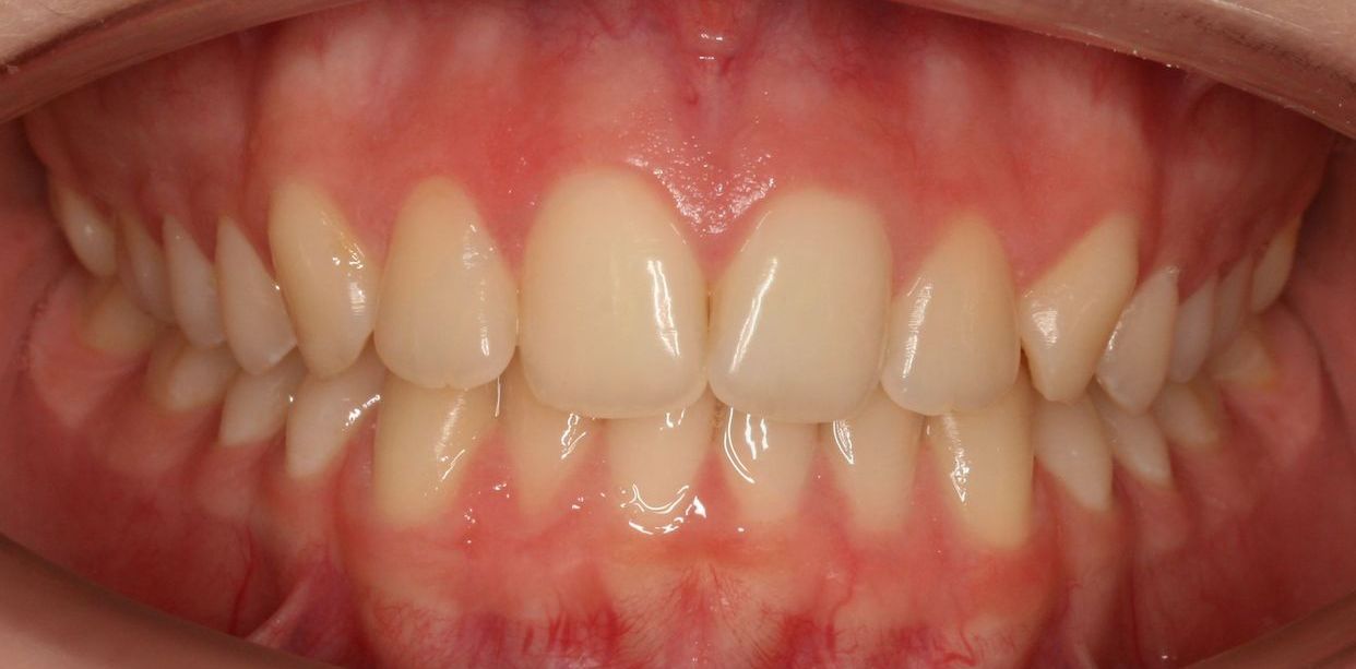 Clear aligner treatment — before