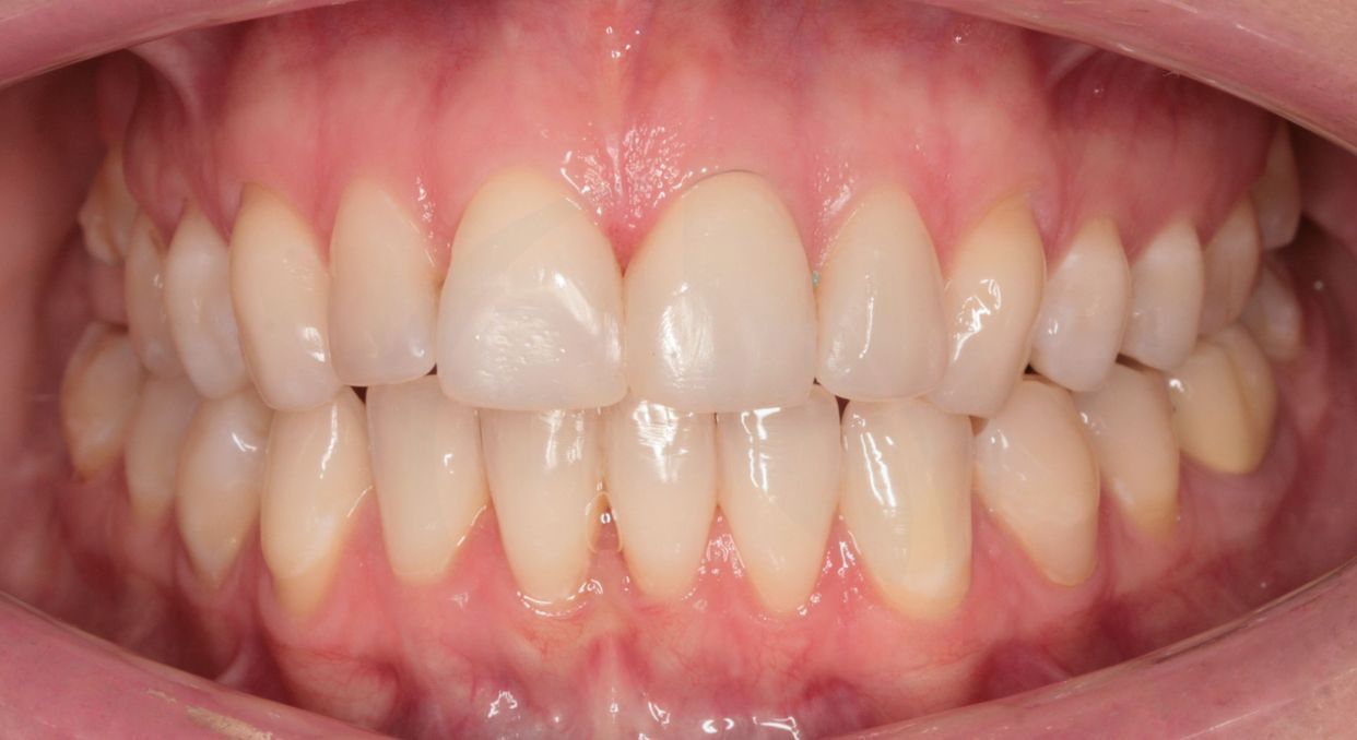 Clear aligner treatment — after