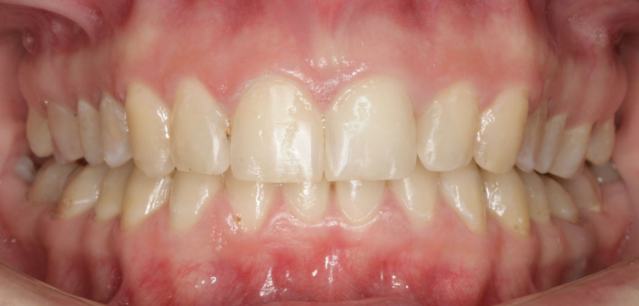 Clear aligner treatment — after