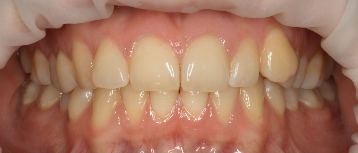 Clear aligner treatment — before