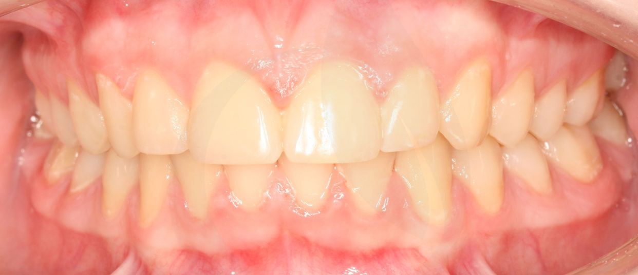 Clear aligner treatment — after