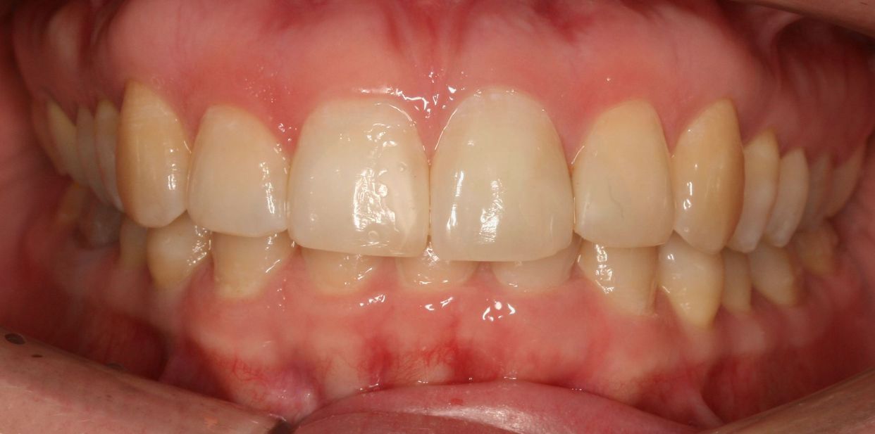 Clear aligner treatment — after