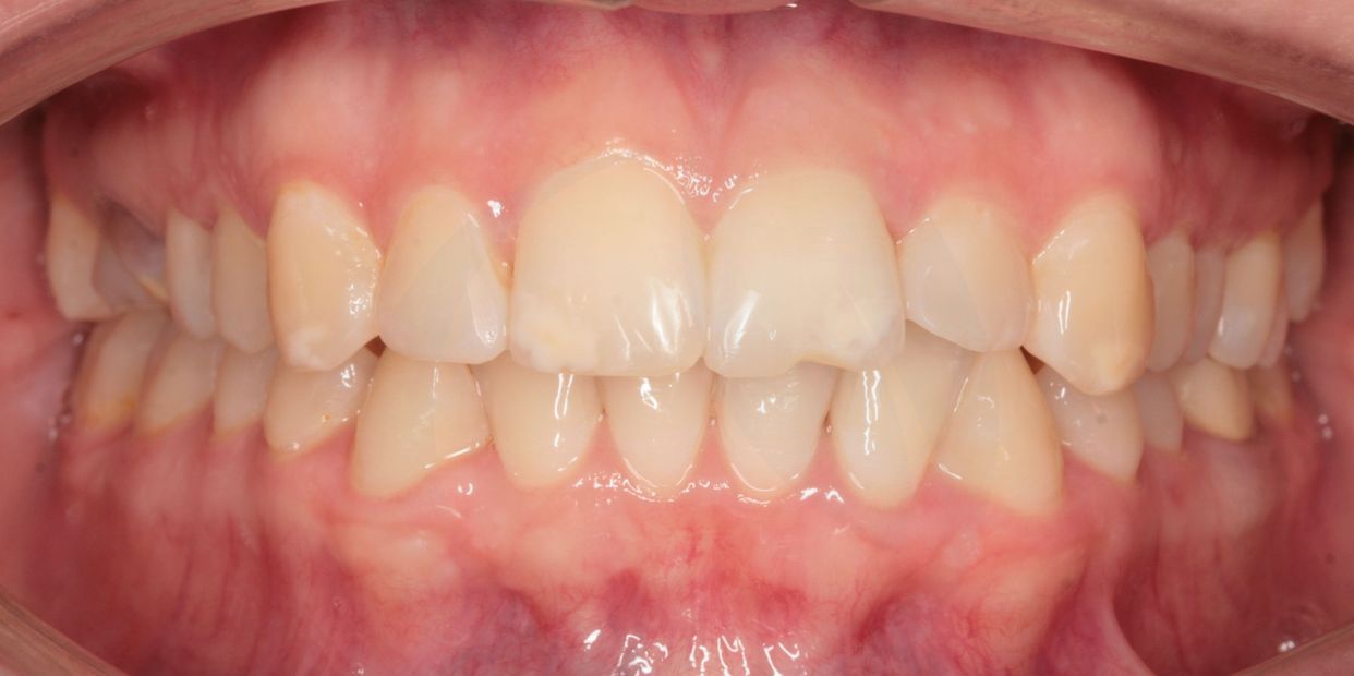 Clear aligner treatment — after