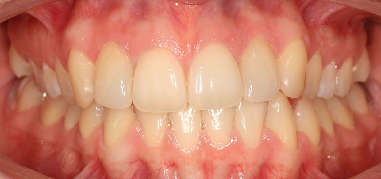 Clear aligner treatment — after