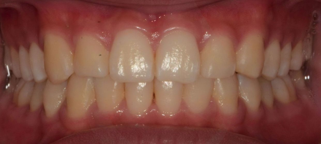 Clear aligner treatment — after