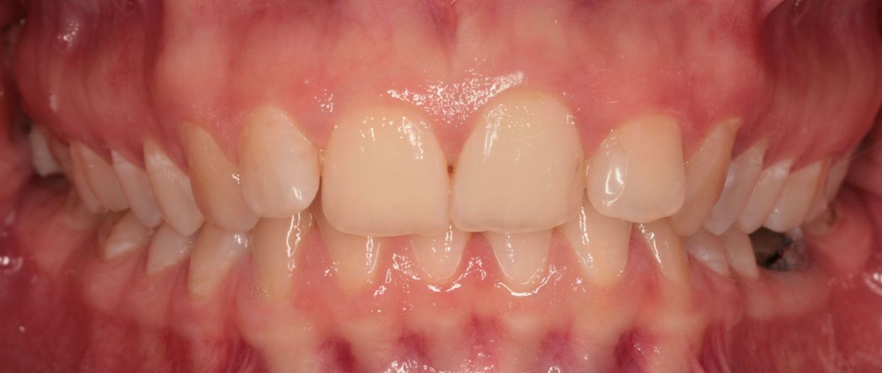 Clear aligner treatment — before