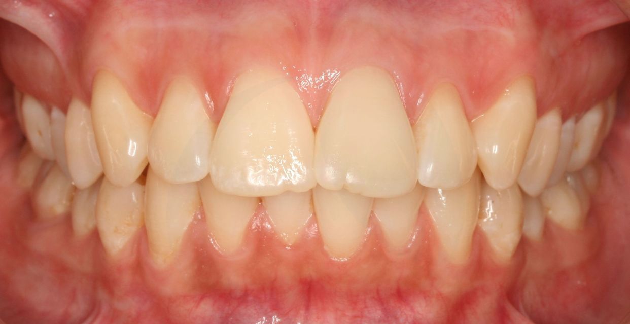 Clear aligner treatment — before