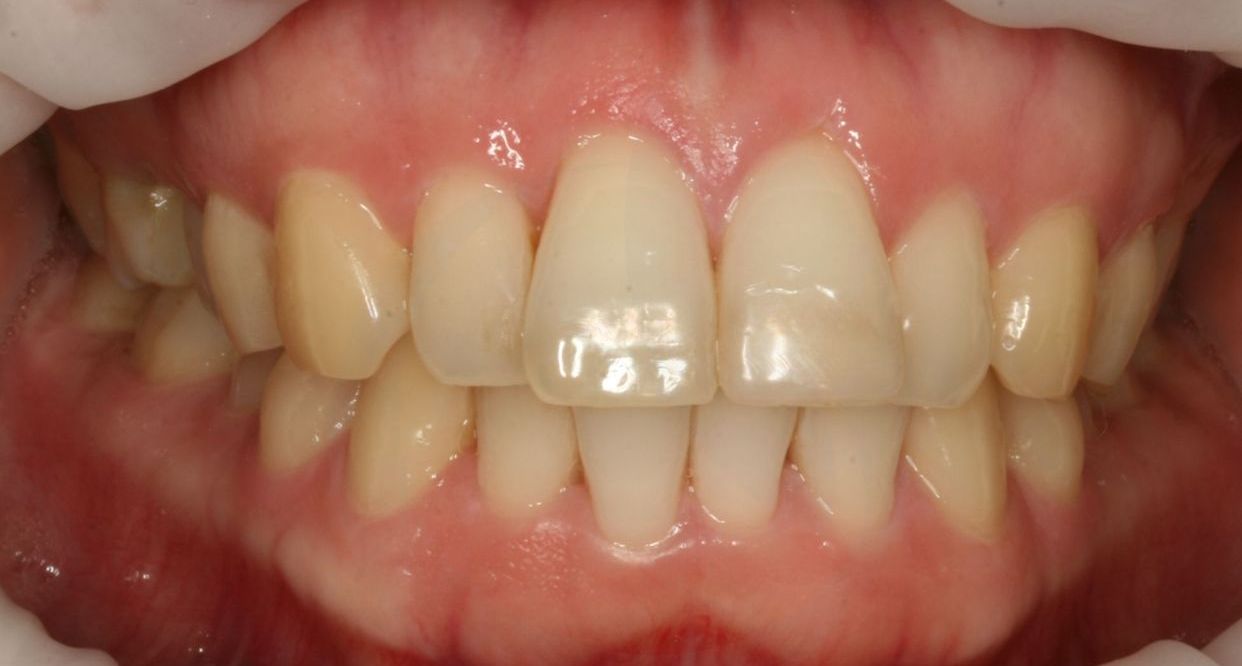 Clear aligner treatment — before