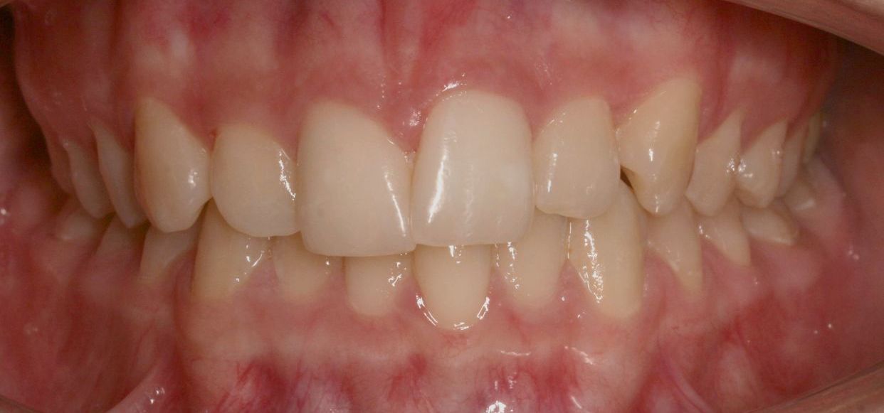 Clear aligner treatment — before