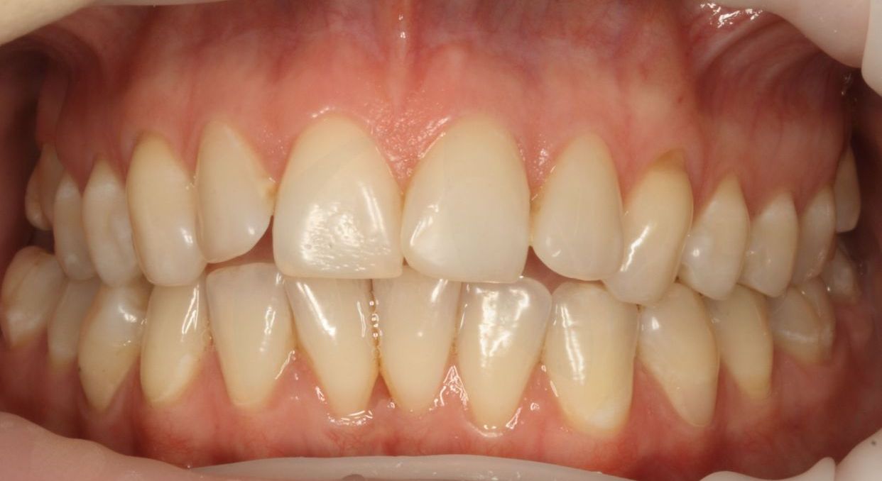 Clear aligner treatment — before