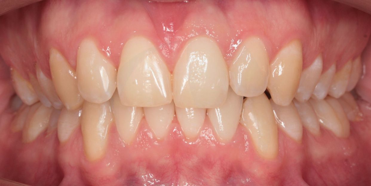 Clear aligner treatment — after