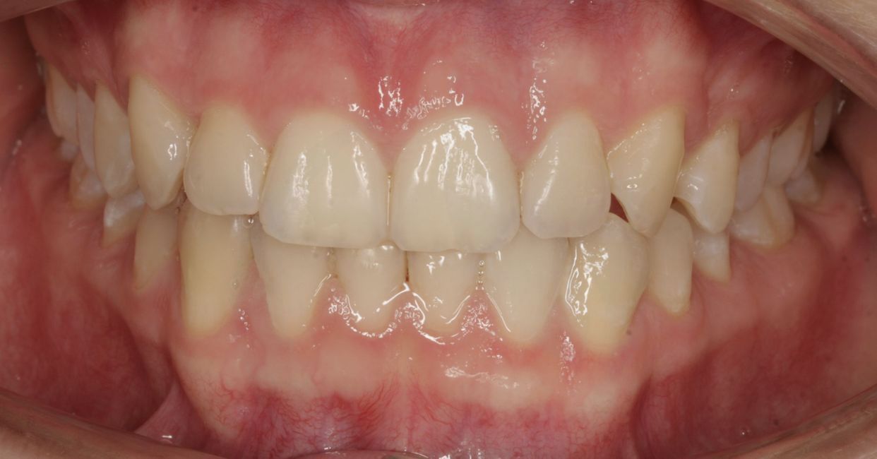 Clear aligner treatment — after