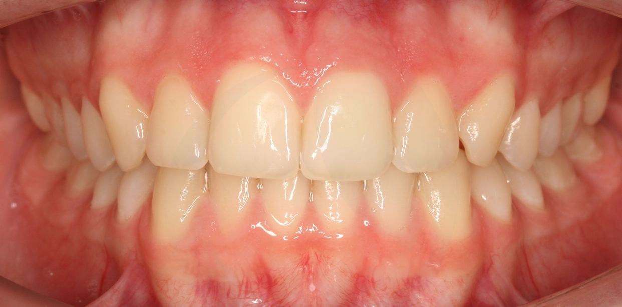 Clear aligner treatment — after