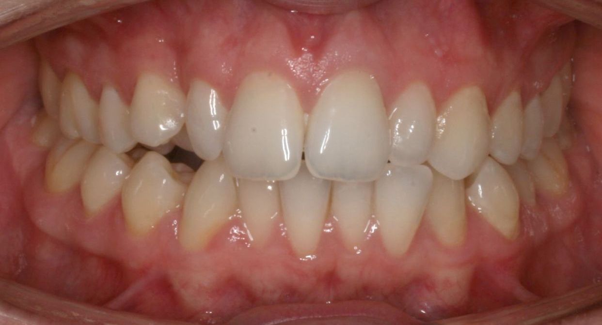 Clear aligner treatment — before