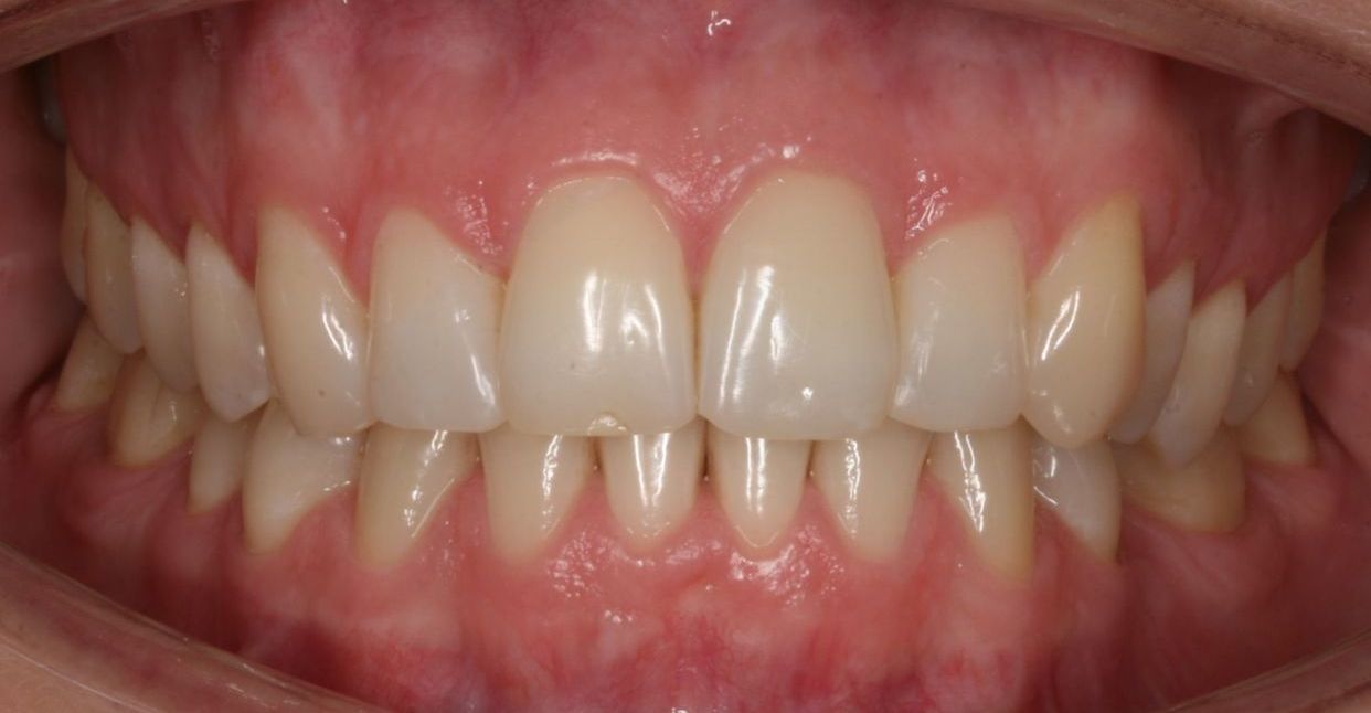 Clear aligner treatment — after