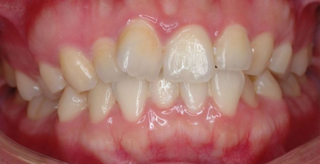 Clear aligner treatment — before
