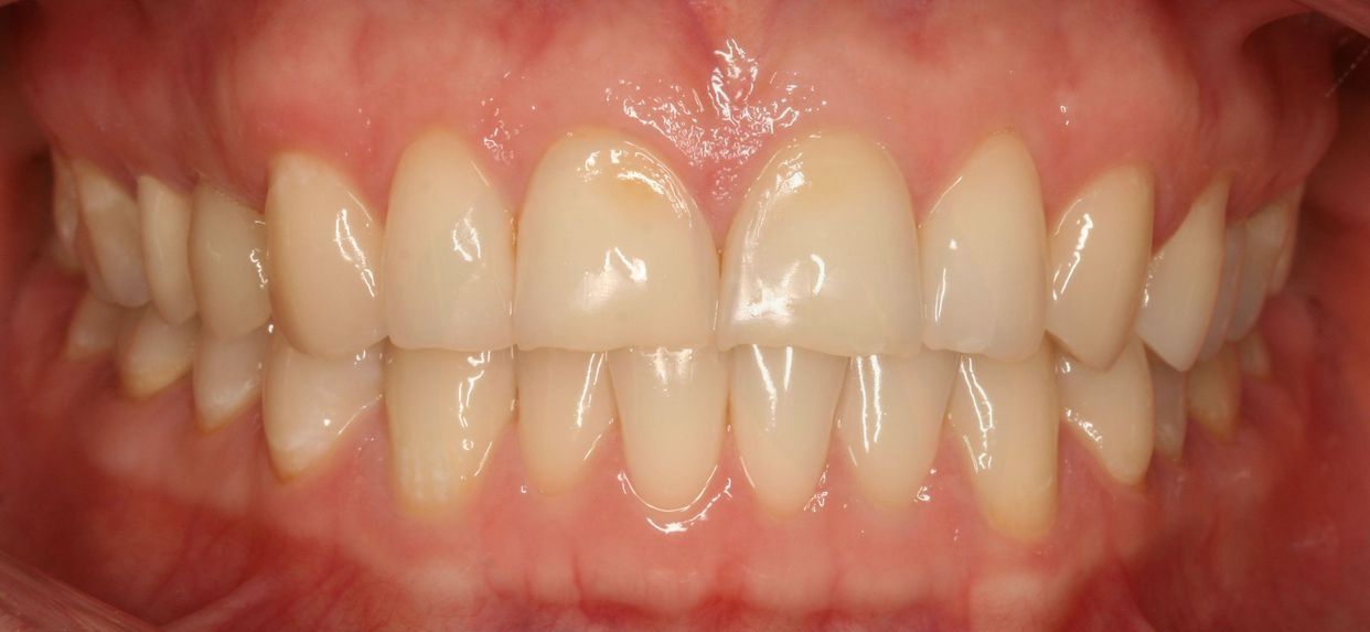 Clear aligner treatment — before