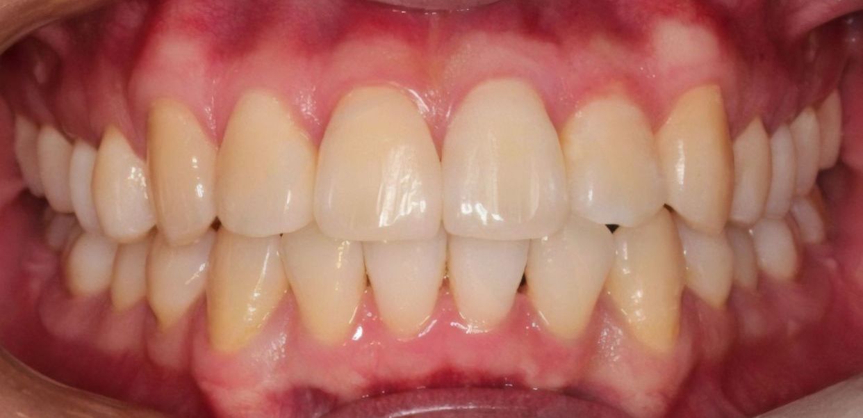 Clear aligner treatment — after