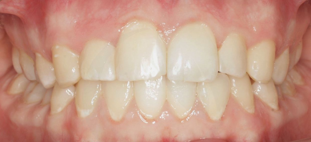 Clear aligner treatment — after