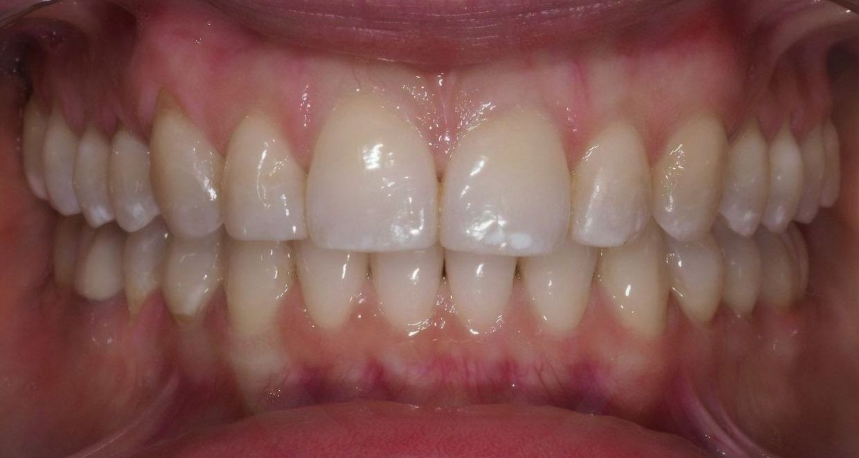 Clear aligner treatment — after