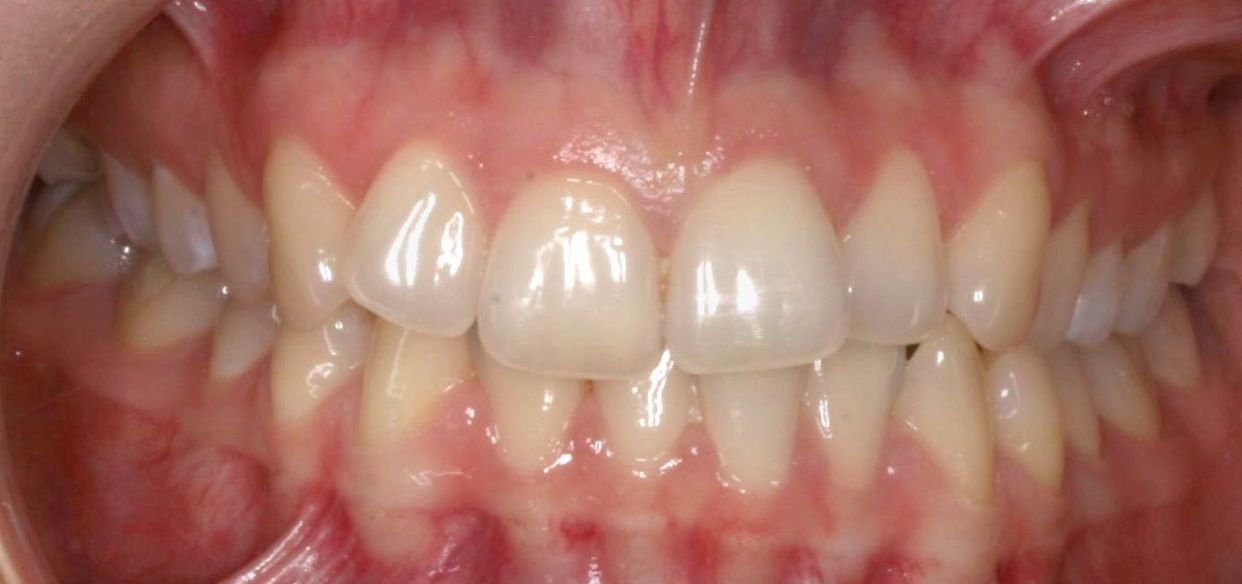 Clear aligner treatment — before
