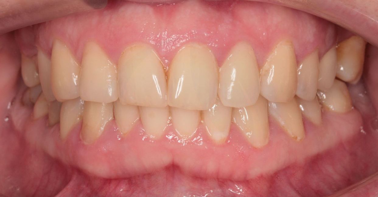 Clear aligner treatment — before