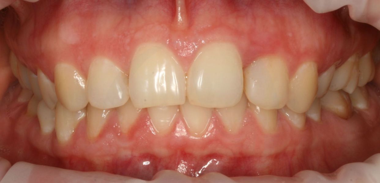 Clear aligner treatment — before