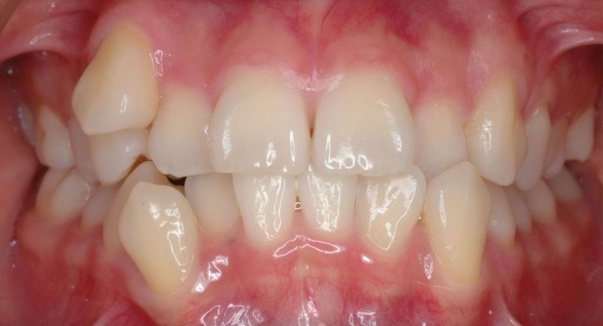 Clear aligner treatment — before