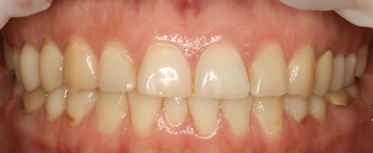Clear aligner treatment — before