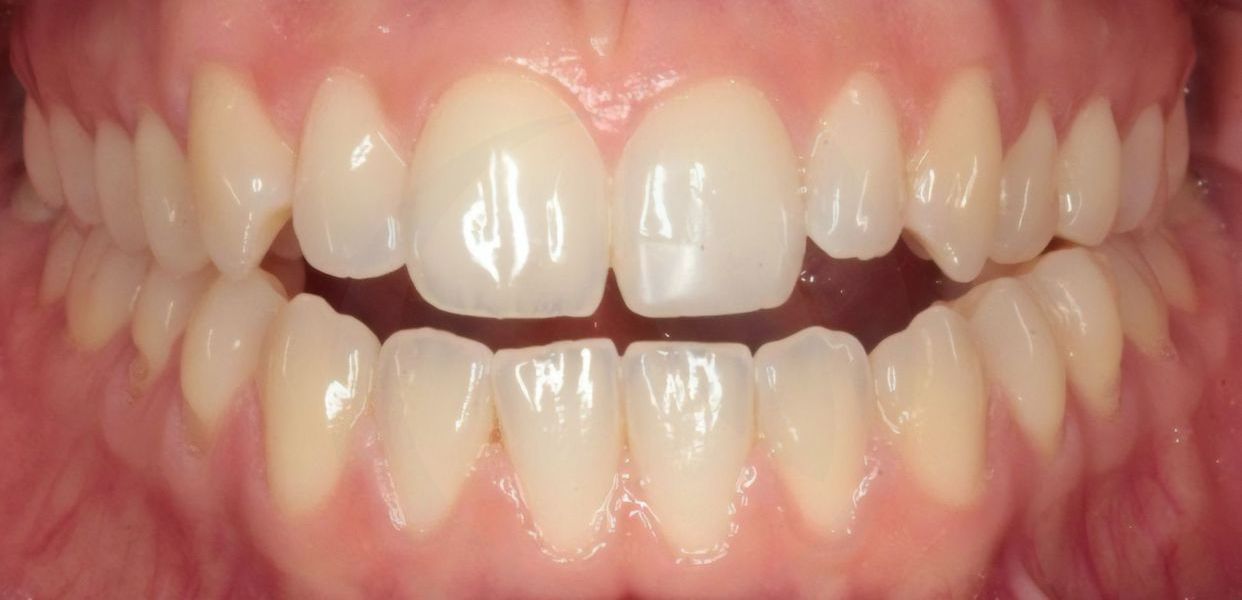 Clear aligner treatment — before