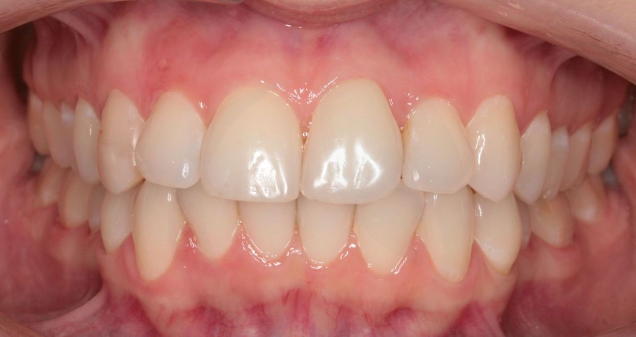 Clear aligner treatment — after